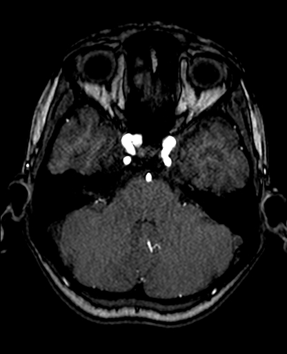 File:Berry aneurysm of the terminal internal carotid artery (Radiopaedia 88286-104918 Axial TOF 80).jpg