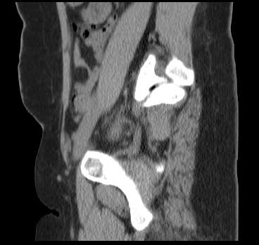 File:Bicornuate uterus (MRI) (Radiopaedia 49206-54296 Sagittal 15).png