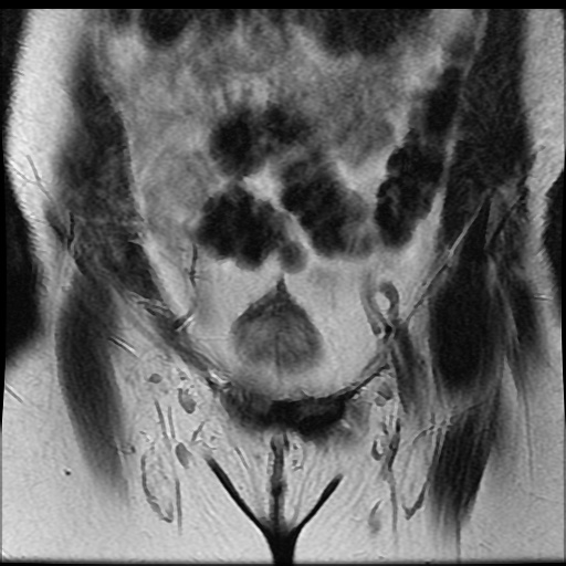 File:Bicornuate uterus (Radiopaedia 51676-57472 Coronal T2 6).jpg