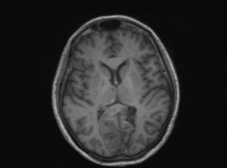 File:Bilateral PCA territory infarction - different ages (Radiopaedia 46200-51784 Axial T1 227).jpg