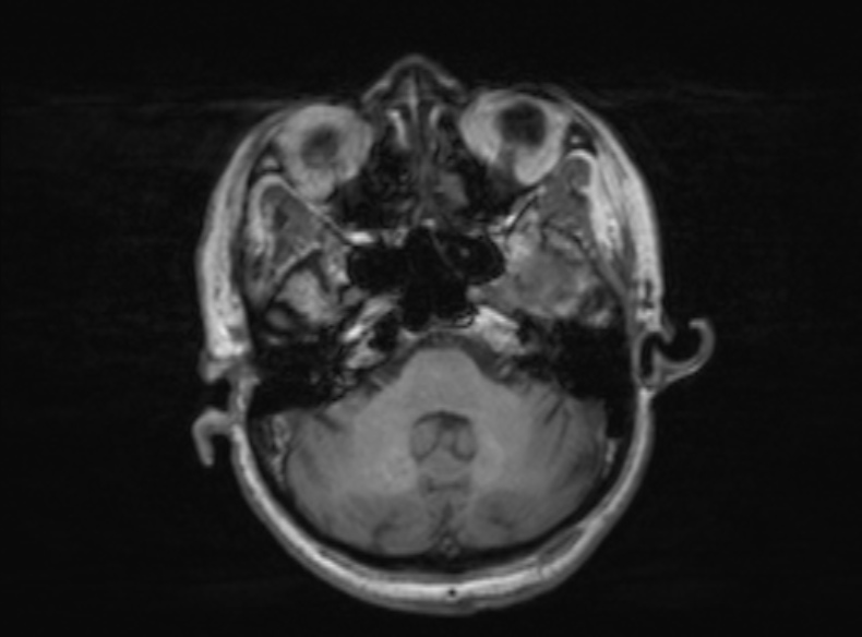 Bilateral PCA territory infarction - different ages (Radiopaedia 46200-51784 Axial T1 307).jpg
