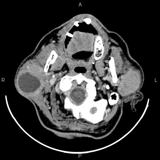 Bilateral Warthin tumors (Radiopaedia 84034-99263 Axial With contrast 18).jpg