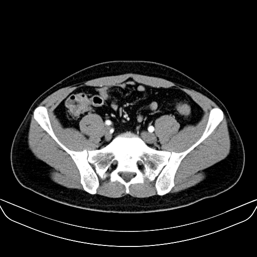 Bilateral accessory renal arteries with mild pelvi-ureteric junction (PUJ) obstruction (Radiopaedia 66357-75596 A 51).jpg