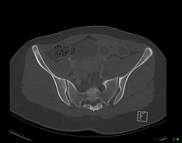 Bilateral acetabular fractures (Radiopaedia 79272-92308 Axial bone window 23).jpg