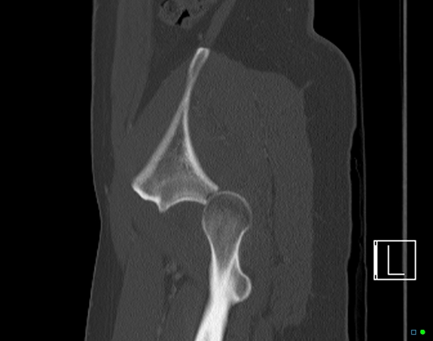 File:Bilateral acetabular fractures (Radiopaedia 79272-92308 Sagittal bone window 74).jpg