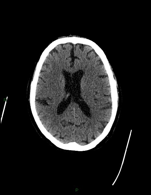 Bilateral acute middle cerebral artery territory infarcts (Radiopaedia 77319-89401 Axial non-contrast 52).jpg
