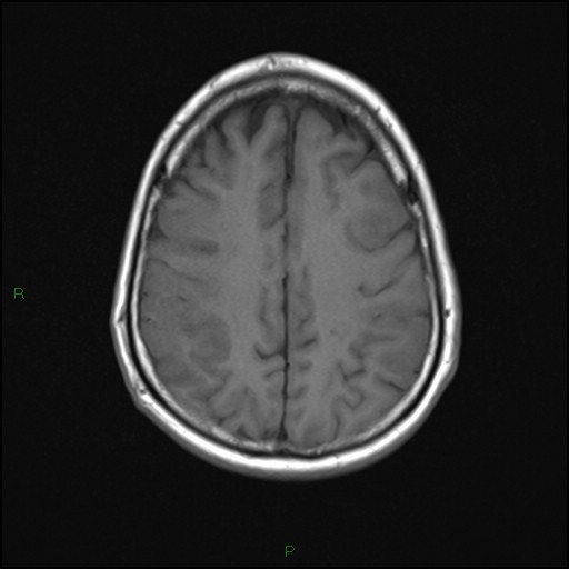 File:Bilateral acute middle cerebral artery territory infarcts (Radiopaedia 77319-89402 Axial T1 18).jpg