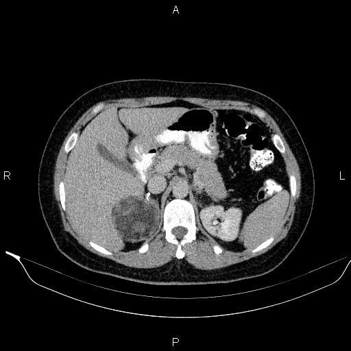 File:Bilateral adrenal myelolipoma (Radiopaedia 63058-71535 Axial C+ delayed 26).jpg
