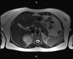 File:Bilateral adrenal myelolipoma (Radiopaedia 63058-71537 Axial T2 12).jpg