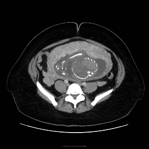 Bilateral adrenal thrombosis (Radiopaedia 58182-65256 A 52).jpg
