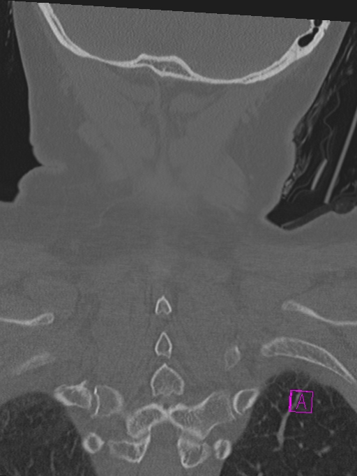 Bilateral atlanto-occipital assimilation (Radiopaedia 28350-28603 Coronal bone window 44).jpg