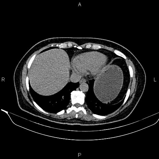 Bilateral benign adrenal adenomas (Radiopaedia 86912-103124 Axial non-contrast 17).jpg