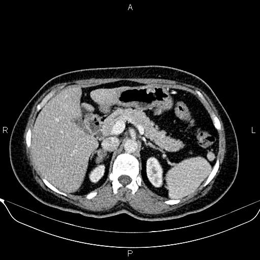 Bilateral benign adrenal adenomas (Radiopaedia 86912-103124 B 34).jpg