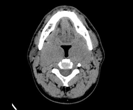 Bilateral carotid body tumors (Radiopaedia 61841-69870 Axial non-contrast 39).jpg