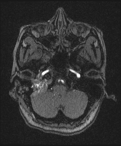 Bilateral carotid body tumors and right glomus jugulare tumor (Radiopaedia 20024-20060 Axial MRA 31).jpg
