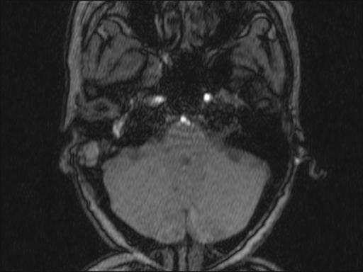 Bilateral carotid body tumors and right glomus jugulare tumor (Radiopaedia 20024-20060 Axial MRA 316).jpg