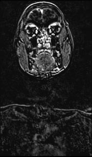 Bilateral carotid body tumors and right glomus jugulare tumor (Radiopaedia 20024-20060 MRA 73).jpg