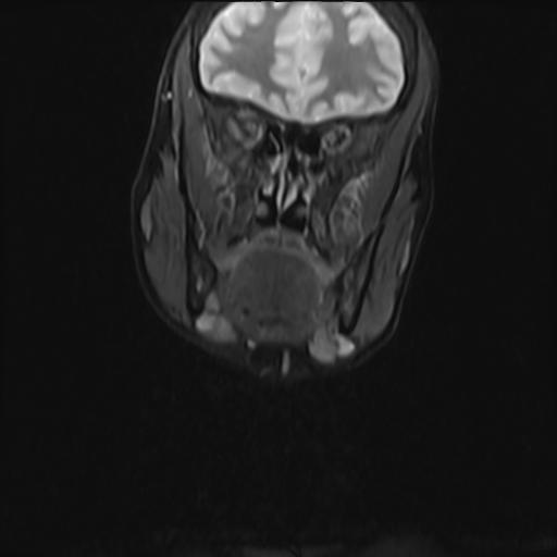 File:Bilateral carotid body tumors and right jugular paraganglioma (Radiopaedia 20024-20060 Coronal 40).jpg
