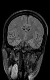 File:Bilateral carotid body tumors and right jugular paraganglioma (Radiopaedia 20024-20060 Coronal 55).jpg