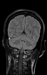 File:Bilateral carotid body tumors and right jugular paraganglioma (Radiopaedia 20024-20060 Coronal 60).jpg