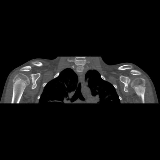 Bilateral chronic posterior shoulder dislocation (Radiopaedia 39213-41452 Coronal bone window 27).jpg