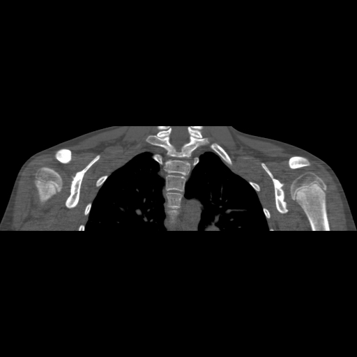 File:Bilateral chronic posterior shoulder dislocation (Radiopaedia 39213-41452 Coronal bone window 35).jpg