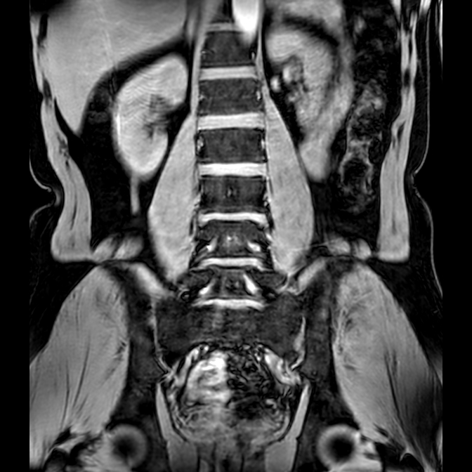 Bilateral conjoined nerve roots at different levels (Radiopaedia 73312-84063 Coronal WE 26).jpg