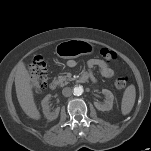File:Bilateral delayed nephrogram from renal artery stenosis (Radiopaedia 47681-52362 A 25).png