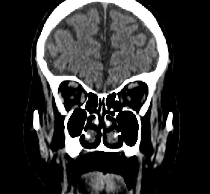 Bilateral ectopia lentis (Radiopaedia 89889-107013 Coronal non-contrast 72).jpg