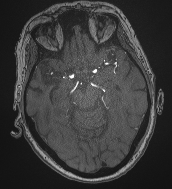 Bilateral fetal posterior communicating arteries (Radiopaedia 41286-44102 Axial MRA 79).png