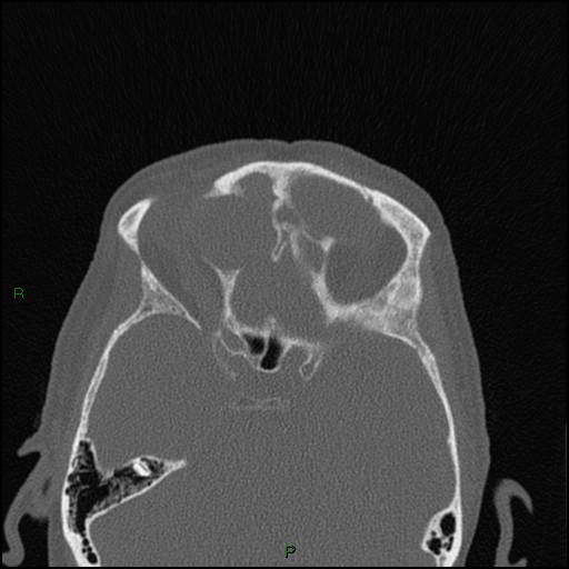 File:Bilateral frontal mucoceles (Radiopaedia 82352-96454 Axial bone window 120).jpg