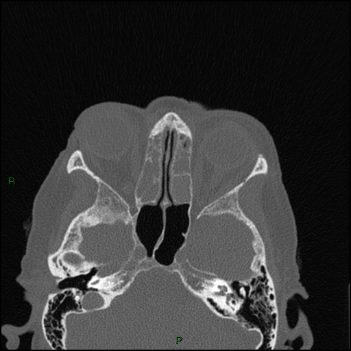 Bilateral frontal mucoceles (Radiopaedia 82352-96454 Axial bone window 146).jpg