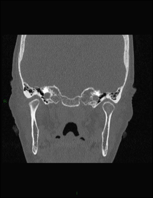 Bilateral frontal mucoceles (Radiopaedia 82352-96454 Coronal 286).jpg