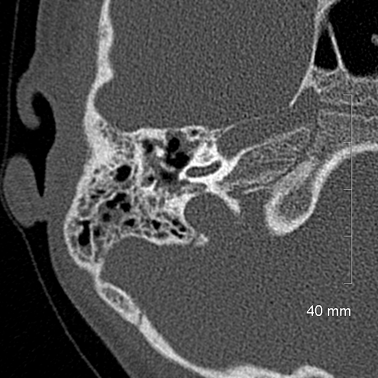 Bilateral grommets (Radiopaedia 47710-52404 Axial bone window 34).jpg