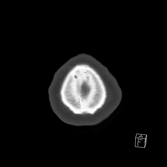 Bilateral occipital condyle fracture (type 2) (Radiopaedia 87675-104089 Axial bone window 118).jpg