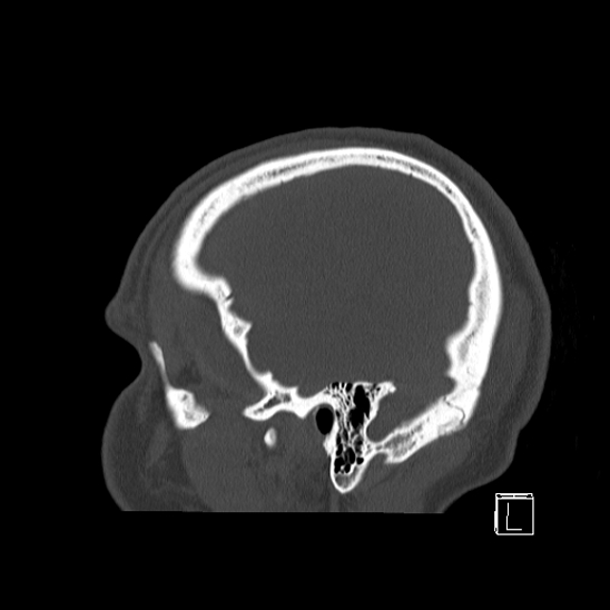 Bilateral occipital condyle fracture (type 2) (Radiopaedia 87675-104089 Sagittal bone window 3).jpg