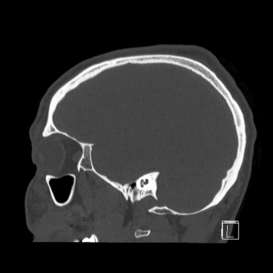 Bilateral occipital condyle fracture (type 2) (Radiopaedia 87675-104089 Sagittal bone window 86).jpg