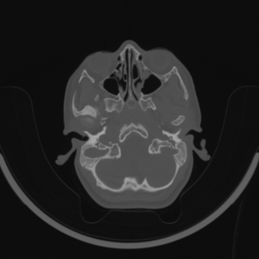 Bilateral otosclerosis (Radiopaedia 57237-64157 C 21).jpg