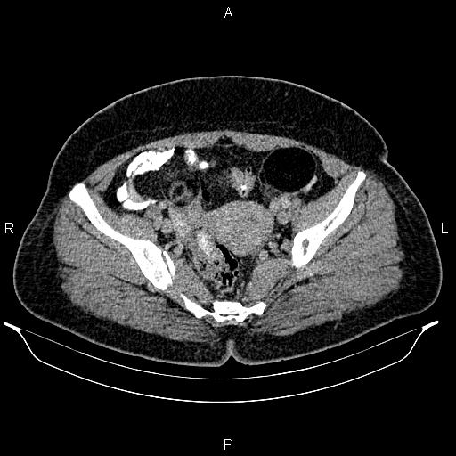 File:Bilateral ovarian dermoid cysts (Radiopaedia 85785-101603 A 88).jpg