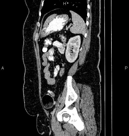File:Bilateral ovarian dermoid cysts (Radiopaedia 85785-101603 D 72).jpg