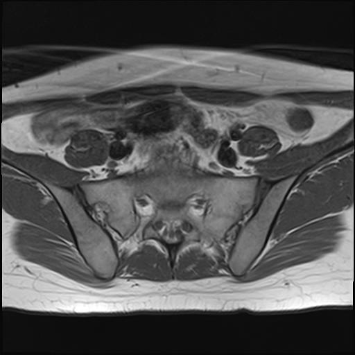 File:Bilateral ovarian endometriomas (Radiopaedia 87085-103347 Axial T1 3).jpg