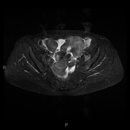 File:Bilateral ovarian fibroma (Radiopaedia 44568-48293 Axial STIR 12).jpg