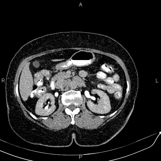File:Bilateral ovarian serous cystadenocarcinoma (Radiopaedia 86062-101989 Axial C+ delayed 22).jpg