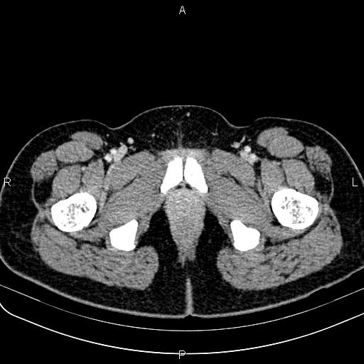 Bilateral ovarian teratoma (Radiopaedia 83131-97503 Axial With contrast 85).jpg