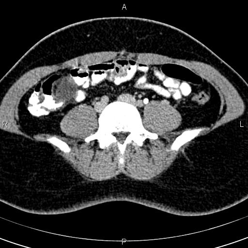 Bilateral ovarian teratoma (Radiopaedia 83131-97503 B 3).jpg