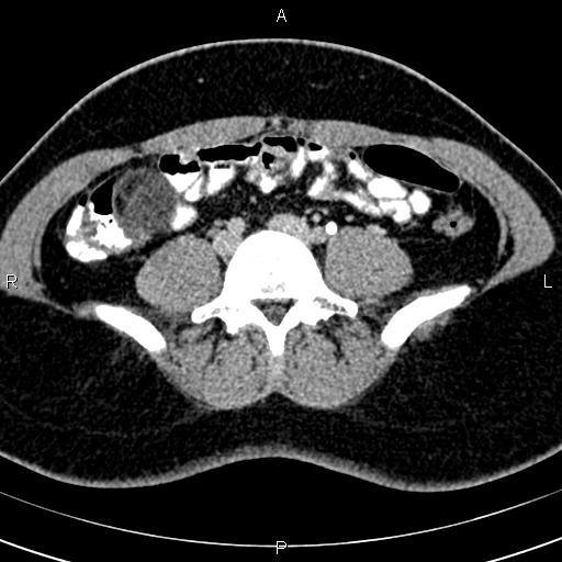 File:Bilateral ovarian teratoma (Radiopaedia 83131-97503 B 4).jpg