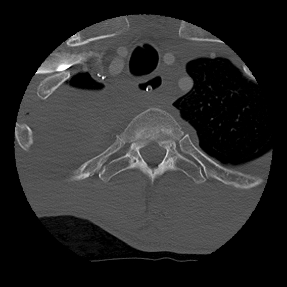Bilateral perched facets with cord injury (Radiopaedia 45587-49713 Axial bone window 110).jpg