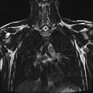 Bilateral spinoglenoid notch ganglion cysts (Radiopaedia 29577-30082 Coronal T2 74).jpg