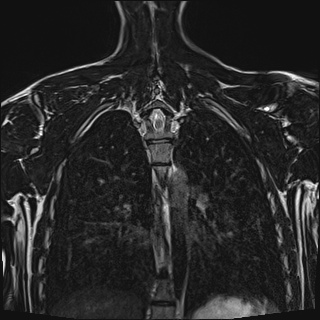File:Bilateral spinoglenoid notch ganglion cysts (Radiopaedia 29577-30082 Coronal T2 93).jpg