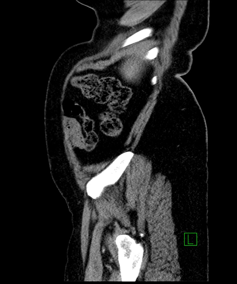 Bilateral sporadic synchronous clear cell renal cell carcinoma (Radiopaedia 85035-100575 E 22).jpg